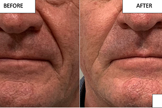Nasolabial Folds — When to Treat and When to Leave Alone?