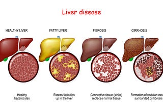 Different types of Liver Disease