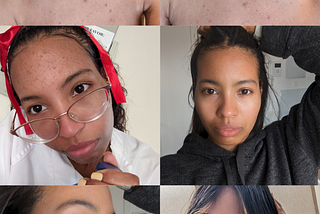 Tretinoin