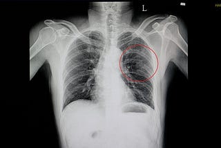 Pulmonary Contusion, Causes, and Symptoms