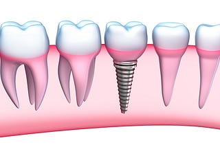 Why Am I A Good Candidate for Dental Implants?