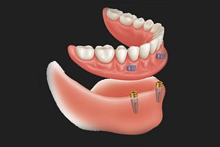 Types of Full Mouth Dental Implants