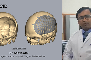 3D Printed FTP Cranioplasty — A Case Study