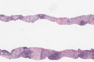 Extra-Nodal, Extra-Nasal EBV-Positive NK/T-Cell Lymphoma