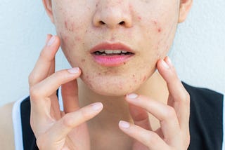 How i wiped out ACNE permanently
