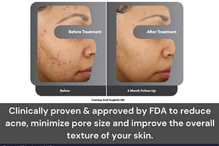 Accure Acne Treatment NYC