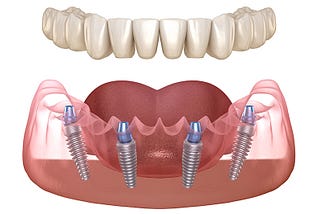 Understanding Dental Implants: Types and Materials Used in India
