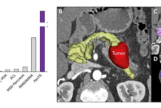 PanTS: A New Benchmark for AI in Pancreatic Cancer Detection