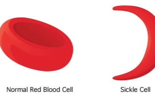 What is Sickle Cell