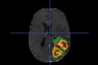 Train a brain tumor segmentation deep learning model for under $10