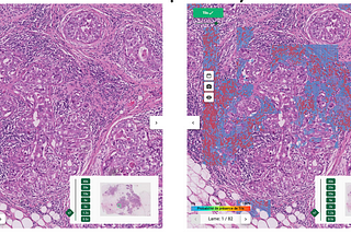 An Automated Tumour Infiltrating Lymphocytes (TILs) Scoring Tool