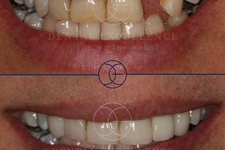 Multiple Dental Implants