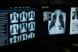 IndoNet : Specific Convolution Neural Network Architecture for a Better Pneumonia Detection System…