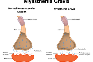 Understanding Myasthenia Gravis: Symptoms, Diagnosis, and Treatment