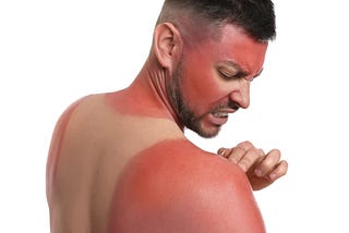 How to treat sunburn
