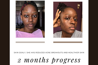 Follow Isabel’s Journey So Far from Acne & Discoloration to Clearer, Healthier Skin.