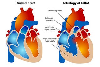 Tetralogy of Fallot in children