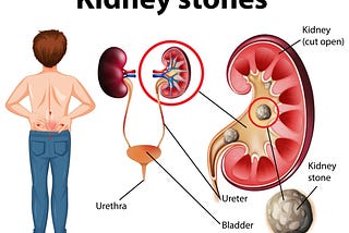 How to Prevent Kidney Stones and Urinary Tract Infections?