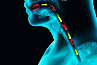 What is Esophageal Perforation?