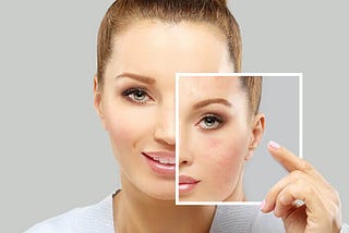 What Your Acne Is Trying To Tell You