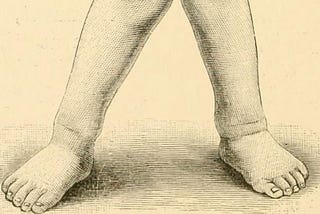 Х-образные ноги: нужно ли их лечить?