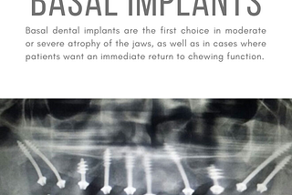 Get Basal Implants To Bring Your Smile Back