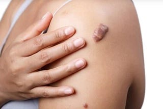 Piercing bump vs keloid: Know the difference and treatment options?