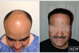 5,000 Grafts Hair Transplant