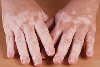 Vitiligo Contagiousness: Understanding the Myths and Facts