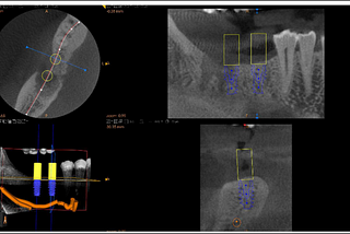 Dental Implants: How Technology Has Revolutionized Treatment Planning