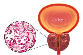 próstata-aumentada