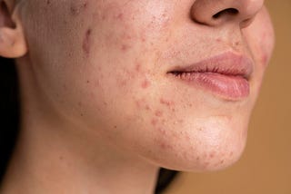 Understanding Folliculitis: Causes, Symptoms, and Treatment