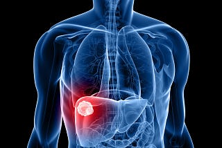 2 Types of Liver Cancer Symptoms to Appear in the Early Stage
