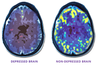 Accelerated TMS for Major Depression