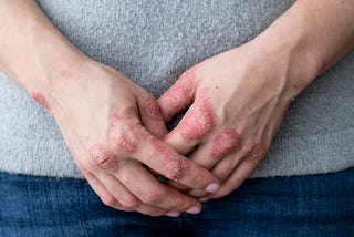 Three Types of Eczema