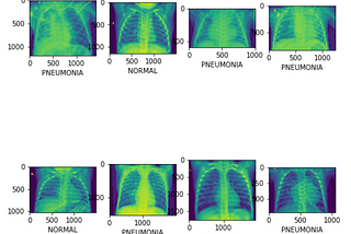 Predicting pneumonia in chest X-Rays
