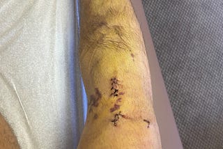 The Infamous ACL Tear: Part 2, The Road to Recovery