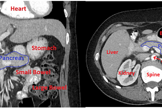 How to Segment a Pancreas CT