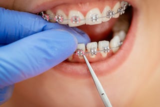 Brace for Brilliance: Maintaining a Radiant Smile with Good Dental Health