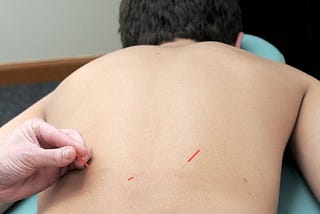 Acupuncture for Low Back Pain
