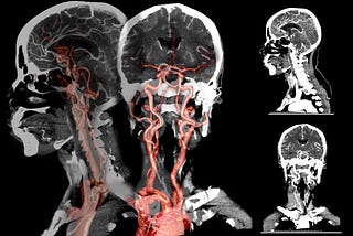 Time is Brain: AI for Acute Stroke Management