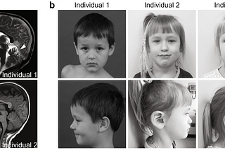 NIH Scientists Discover A Rare Genetic Brain Disorder Making Children Suffer Motor, Speech…