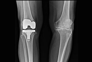 Knee Joint Preservation: Why and How It’s Done?