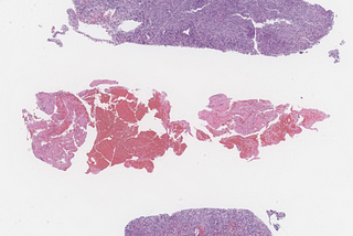 CD10+ Large B-Cell Lymphoma, Arising in the Context of AITL in the Liver