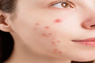 HOW TO DO AWAY WITH ACNE SKIN PROBLEM