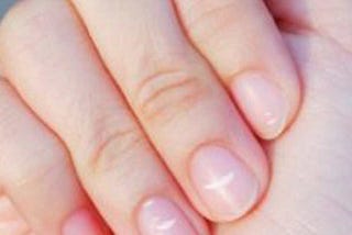 Reasons And Treatments For White Spots On The Nails