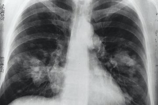 Training Networks to Identify X-rays with Pneumonia