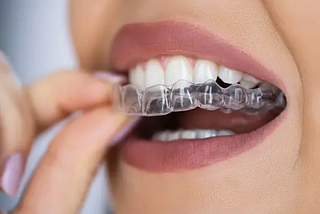 5 Things I Wish I’d Known Before Getting Invisalign