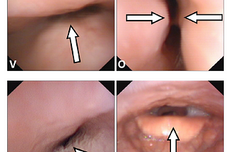 Brief Review — Snoring classified: The Munich-Passau Snore Sound Corpus