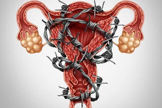 A quite long read about Endometriosis